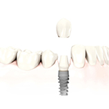 Implantolgie eines Zahnes mittels navigierter Implantation