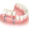 Implantat Zähne - Dr. Matheis