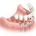 Implantatbrücke - Dr. Matheis