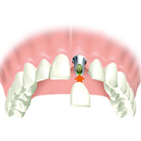 Implantat oder Brücke - Dr. Matheis