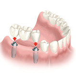 Implantat bei fehlenden Zähnen