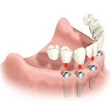 Implantat für alle Zähne eines Kiefers