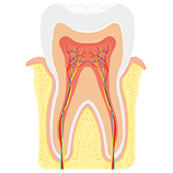 Wurzelbehandlung beim Zahnarzt - Zahnbehandlung in Vollnarkose
