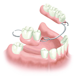 Abnehmbarer Zahnersatz in Form einer Zahnprothese