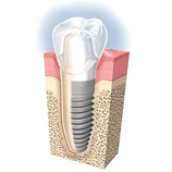 Zahnberatung bei Implantat - Dr. Matheis